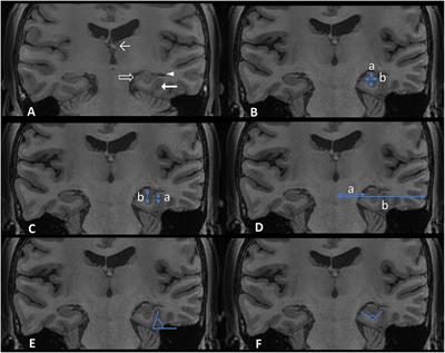 Hippocampal Malrotation Could Be Less Significant in Epilepsy Caused by Focal Cortical Dysplasia Type I and Type II